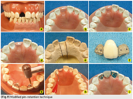 Perma Pin Pin Retained Resin Bonded Bridge System Id Buy