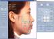 人头测量法分析& Maxillo-脸部外科手术模拟