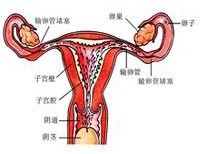 输卵管通而不畅如何治疗？怎么治疗？中药通管胶囊，不遭罪