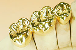 the anchoring of a crown bridge or denture