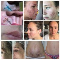 CO2 Laser System Fractional Machine Skin Renewing Wrinkle Scar Removal Acne Teatment Device 6