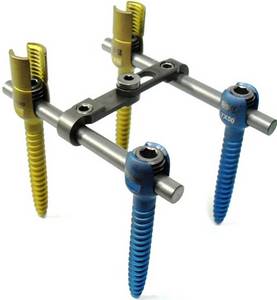Wholesale cortical screws: INFINA Spinal System
