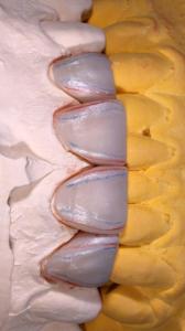 Wholesale Other Dental Supplies: Zirconia Crowns | Durable & Natural for Molars  E.Max Crowns | Lifelike Translucency for Anterior Te