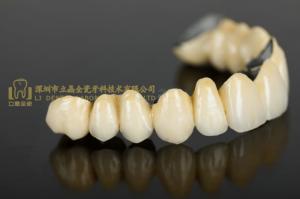 Wholesale fuse: Dental Crown Porcelain Fused Metal,PFM,Dental Prothesis Laboratoire Dentaire,Dentallabor,Dental Lab