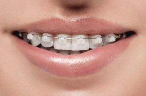 Wholesale e: Factory Offer Directly High Quality Orthodontic Dental Ceramic Self-ligating Brace OEM&ODM