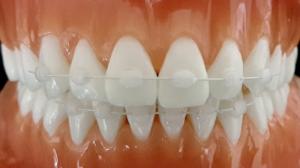 Wholesale teeth aligner: Ssarack Brackets