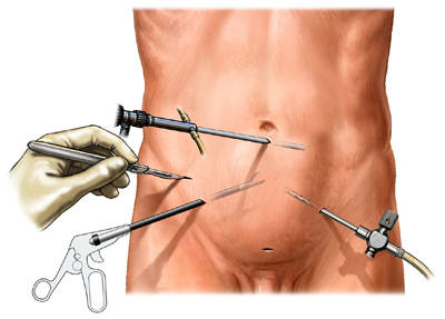 Laparoscopic Instruments - Takam Traders