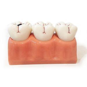 Wholesale Dental Unit: Caries Model