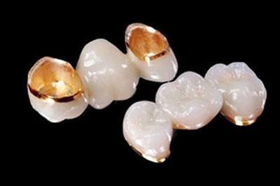 Sell Porcelain-Fused-to-Metal (PFM) Crowns