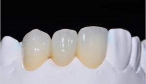 Wholesale e: Dental Treatment Dental Metal Ceramic Crown Made  Dental Lab in